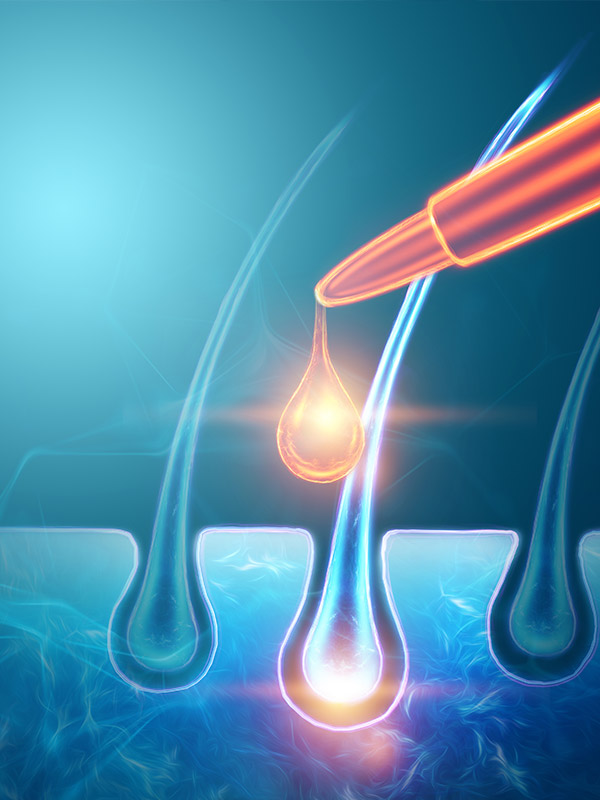 雄激素性脱发(AGA)